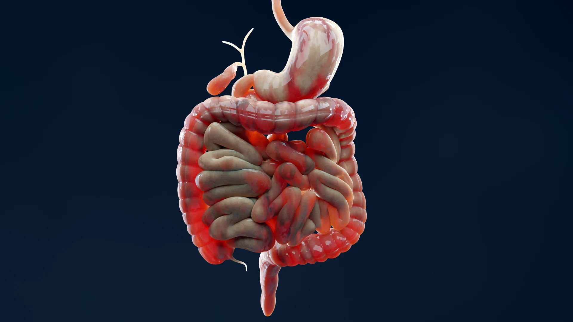 Inflammatory Bowel Disease